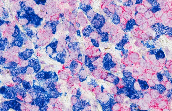 Breast cancer cells, photo credit: National Cancer Institut, Unsplash