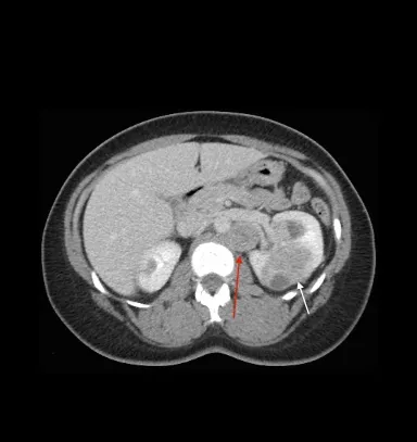 Axial view of an individual’s midsection showing tumors in both kidneys, photo credit: Brian Shuch, MD, Yale University School of Medicine, National Cancer Institute