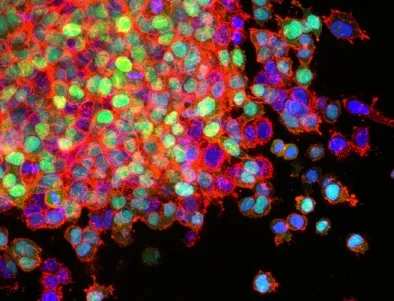 Lung Cancer Metastasis, photo credit: Scott Wilkinson, Adam Marcus, National Cancer Institute \ Winship Cancer Institute of Emory University
